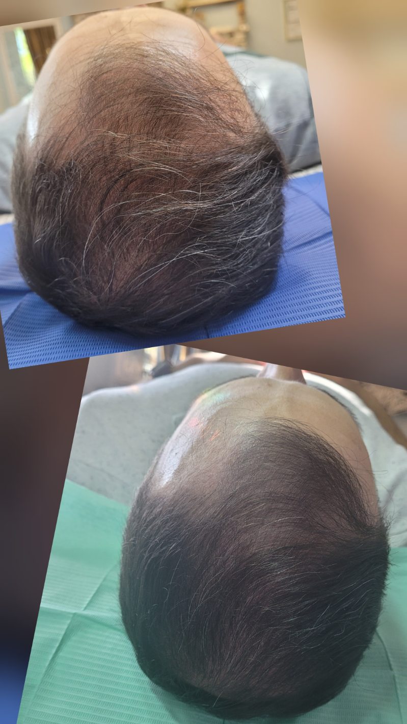 Hair Regeneration Treatment
