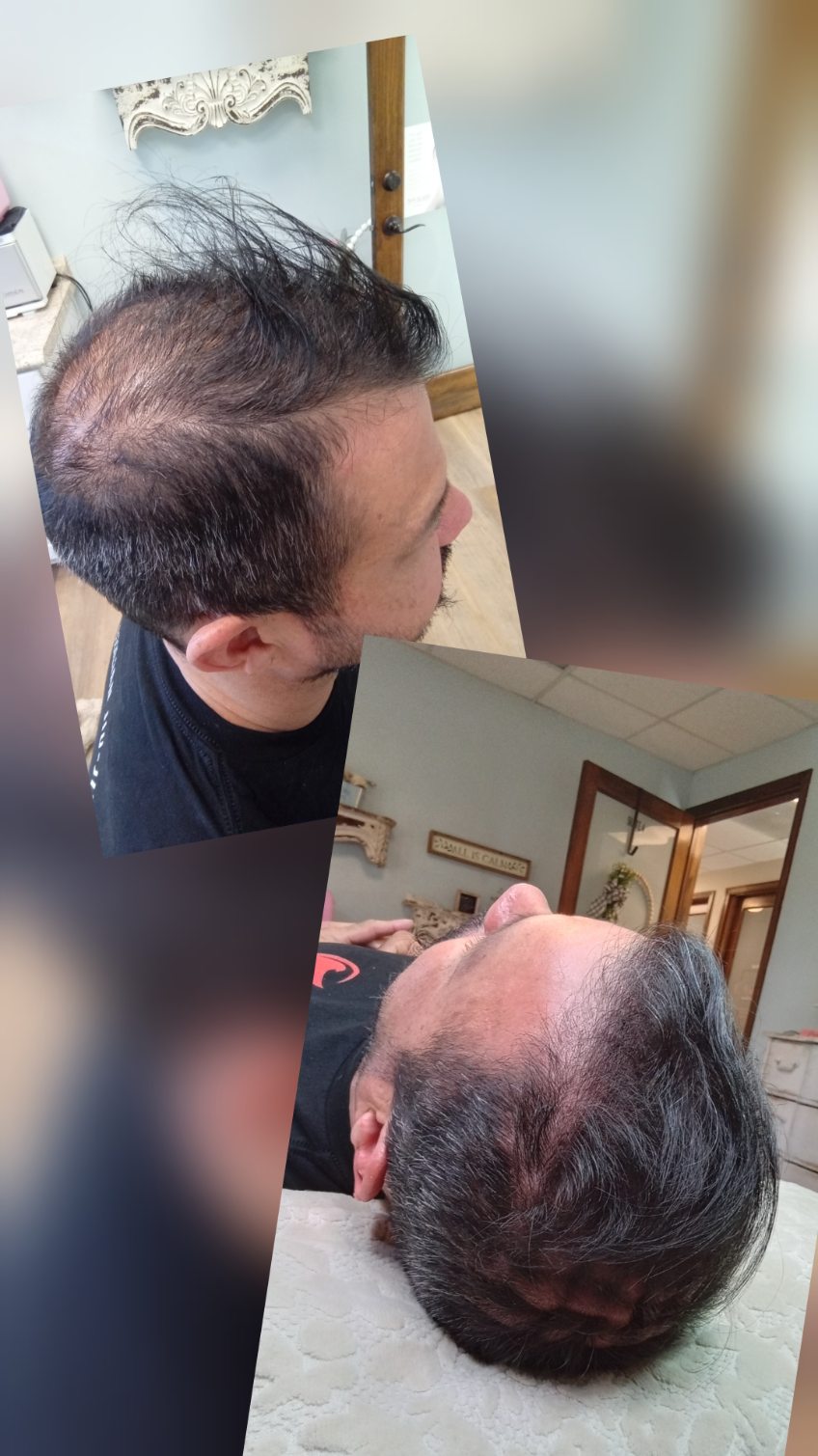 Hair Regeneration Treatment