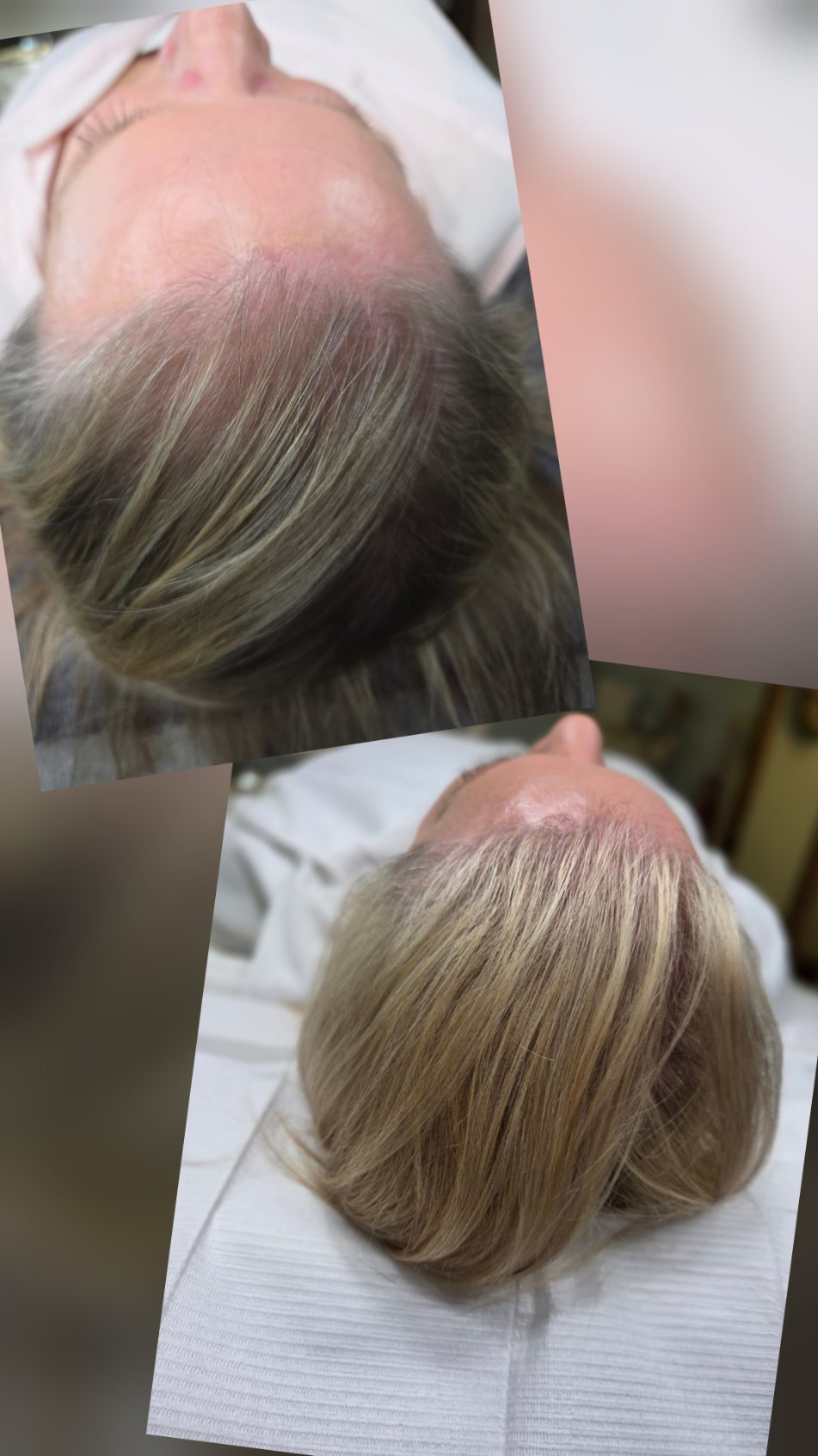 Hair Regeneration Treatment