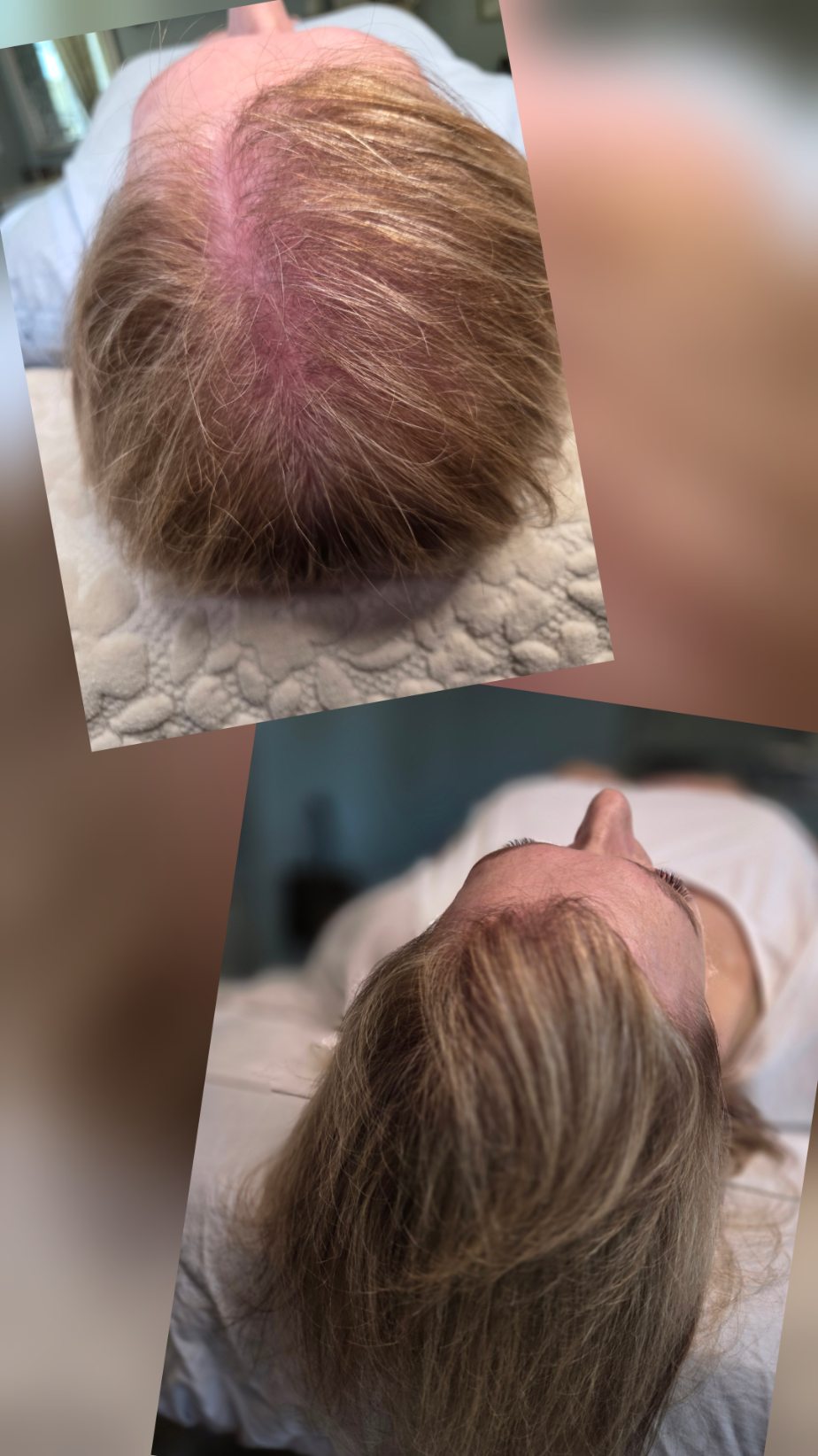 Hair Regeneration Treatment